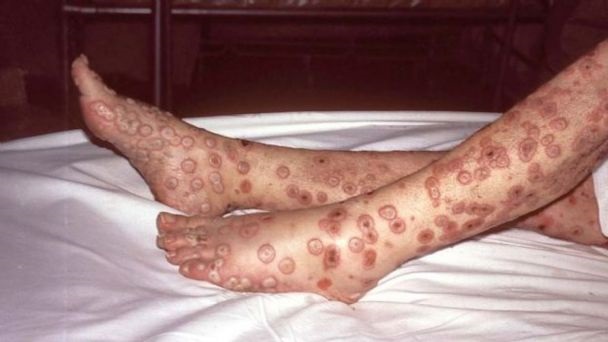 Bolívia confirma nesta quinta-feira (26) o primeiro caso suspeito da varíola do macaco